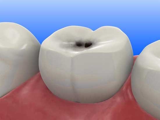 dental cavities